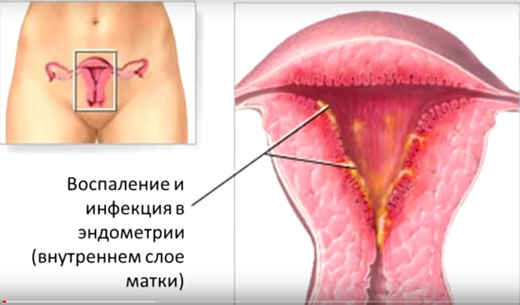 Удаление полипа матки методом гистероскопии, этапы операции, результат